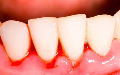 Cần xử lý như thế nào khi bị viêm lợi, chảy máu chân răng?